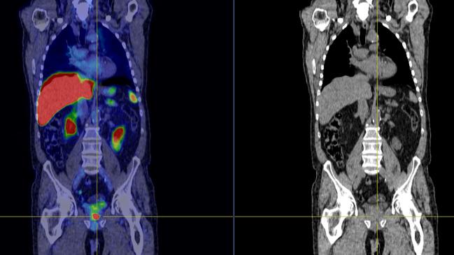 PET/CT imaging shows intense uptake of the tracer within theprimary lesion of the prostate gland (in the cross-hairs), in a patient with newly diagnosed Prostate Cancer. Also shows the prostate cancer has not spread anywhere else. Supplied: Benson Radiology.