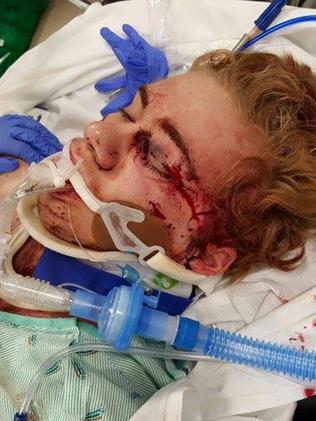 The impact of Skylar Fish’s fall crushed his eye socket, cheekbone and caused bleeding on his brain that required immediate surgery. Picture: Facebook / Siemny Kim