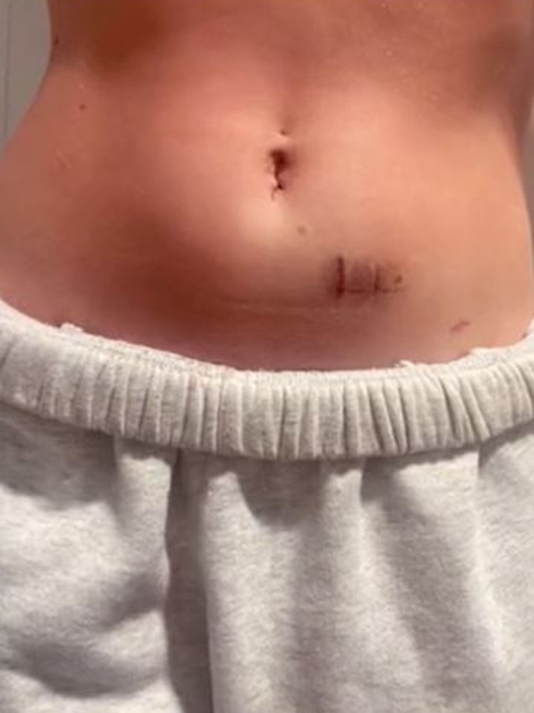 She was diagnosed with stage four endometriosis. Picture: Ella Collings/TikTok