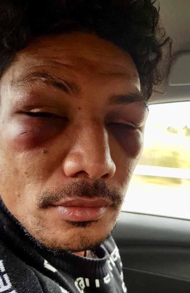 Lopeti Timani the day after he was allegedly punched by Melbourne Rebels teammate Amanaki Mafi.