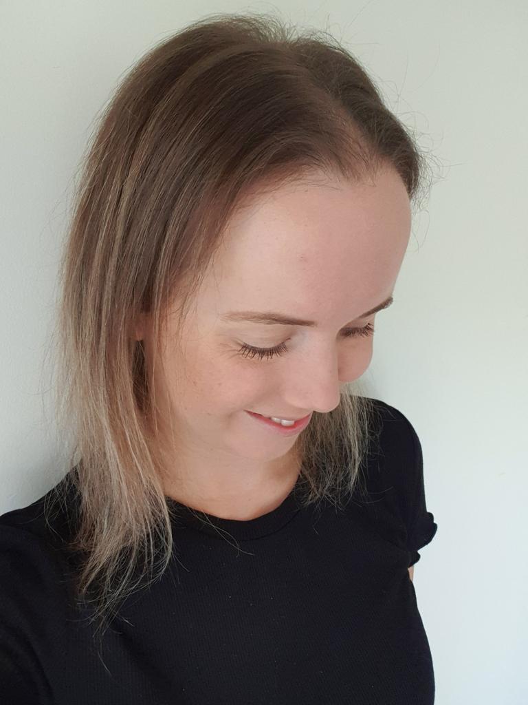 Alopecia Woman Shares Amazing Hair Loss Journey On Instagram Herald Sun