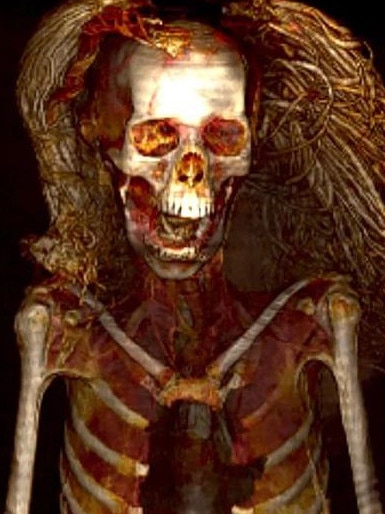 The study involved doing X-rays of the mummy. Picture: Sahar Saleem