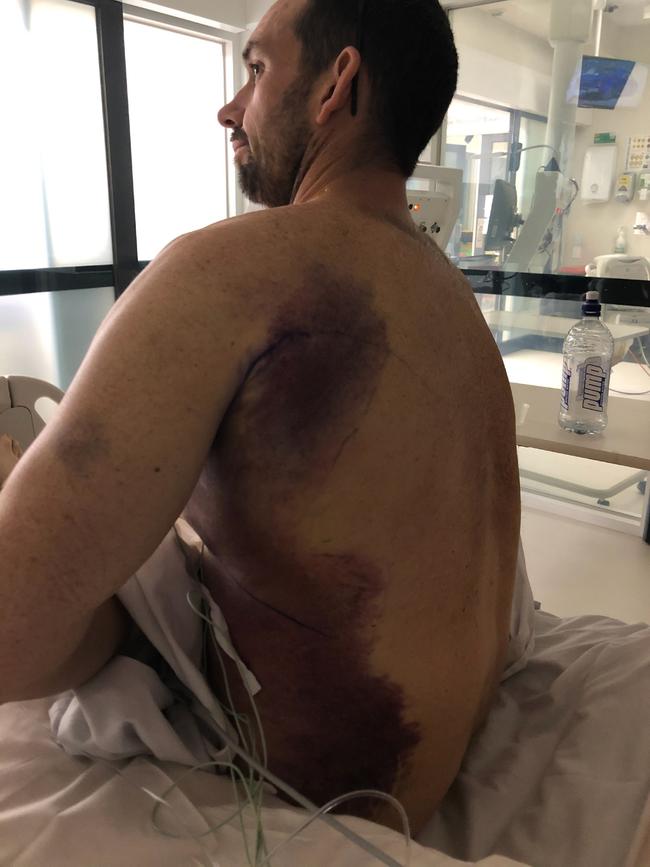 Chris Farrington’s bruising was as a result of internal haemorrhage due to Desseminated Intravascular Coagulation.