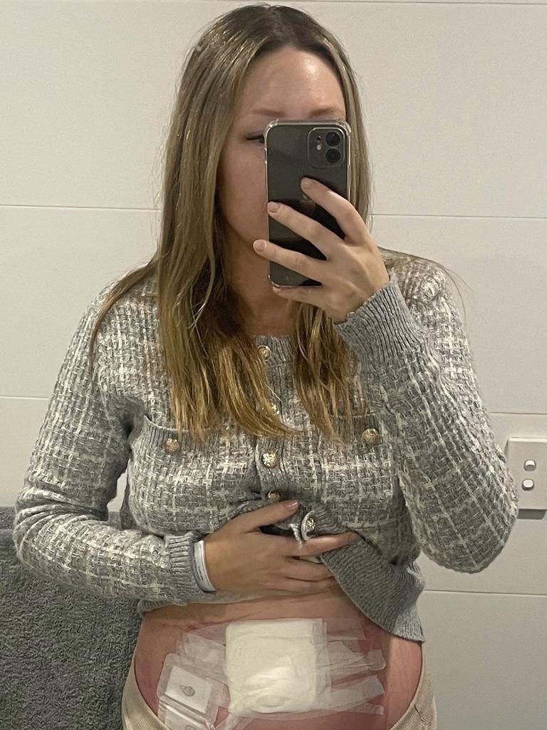 Mary Houghton shows off her swollen belly post surgery. Picture: Supplied