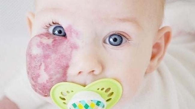 Baby With Birthmark On Cheek: Photo Goes Viral | News.com.au ...