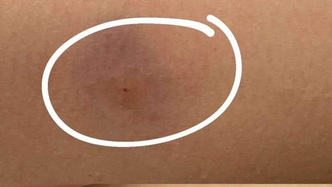 A woman found a needle mark on her right thigh (above) after falling ill and being hospitalised in Newcastle last week. Picture: Supplied.