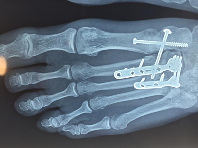 An X-ray of paramedic Paul Judd’s foot after his attack.