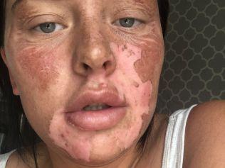 A mum has suffered horrific facial burns after a microwave egg poaching hack went wrong. Picture: Kennedy News