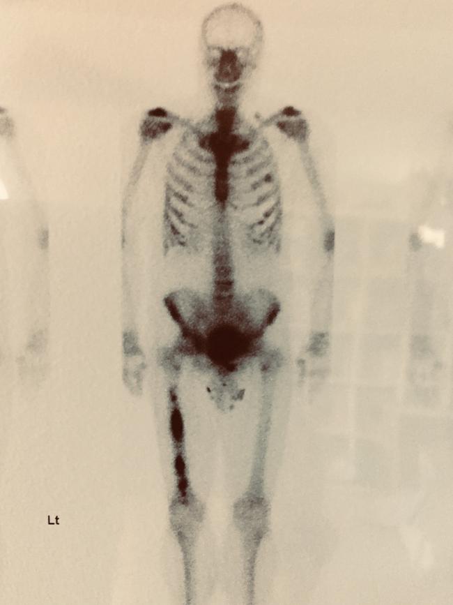 Baker’s bone scan on diagnosis, showing a tumour in his right femur and left rib. Picture: Supplied