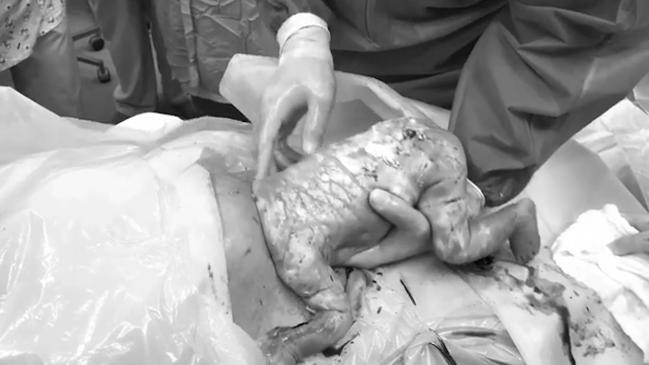 Breech caesarean birth: video captures baby born feet first