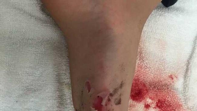 Grace Hagley&#39;s foot suffered second degree burns when she walked through sand barely covering a piping hot fire that had not been properly extinguished on Rainbow Beach.