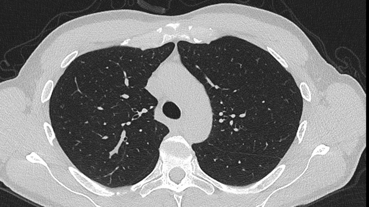 Coronavirus: CAT scans reveal the damage Covid-19 does to the lungs ...