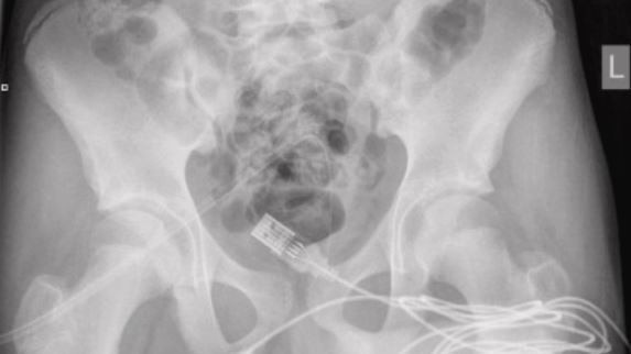 A boy inserted a USB cable into his penis. Picture: Science Direct