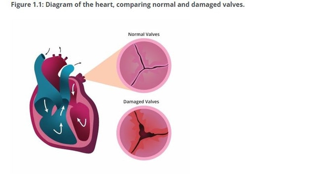 How rheumatic heart disease damages heart valves. Picture: AIHW