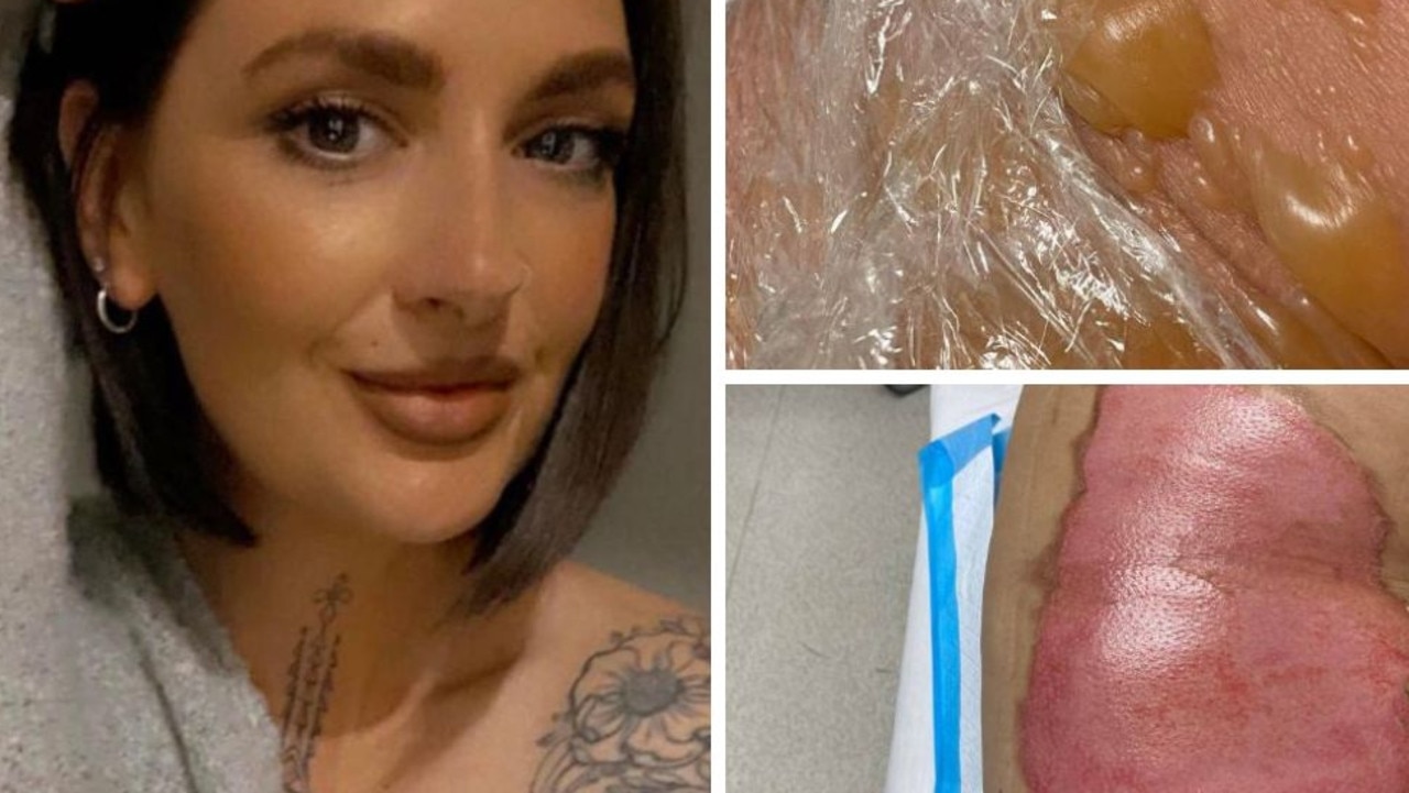 Qld mum's warning as out-of-date hot water bottle bursts, scalding