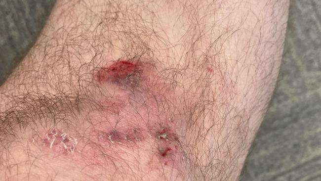 USYD student George Boone grazed his knees crawling past protesters today. Supplied