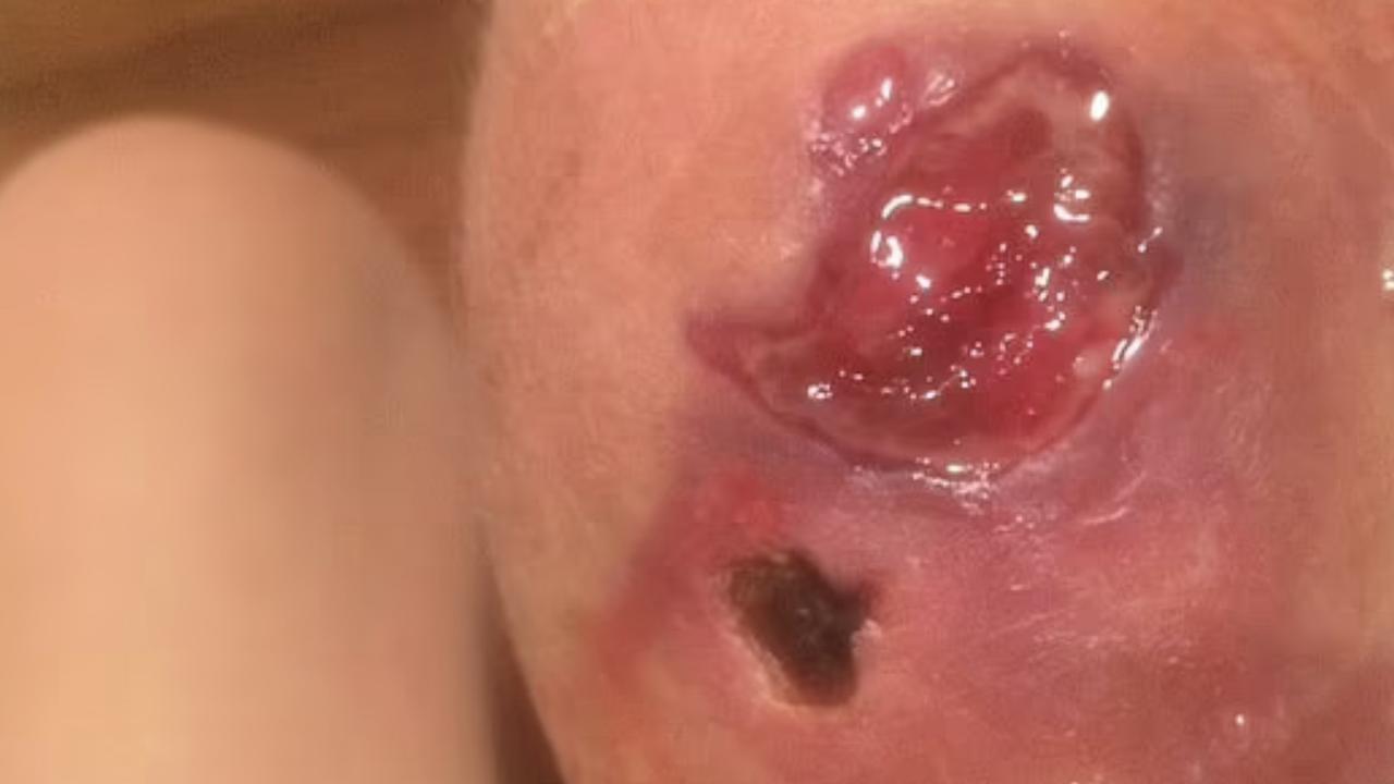The lesions usually present as a slowly developing painless nodule. Picture: Supplied