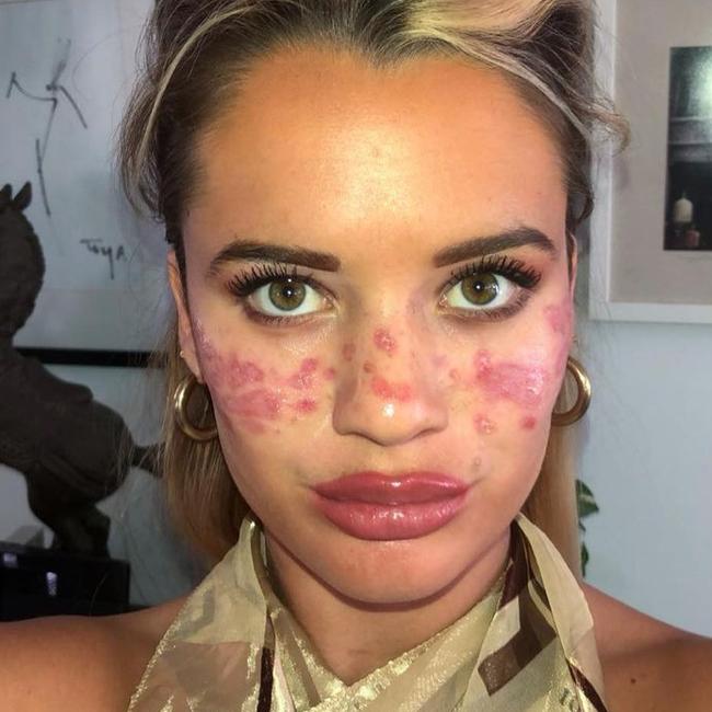 Big Brother beauty Tilly Whitfield's face has black scarring more than a year after she tried to inject her own tattoo freckles after watching a TikTok tutorial. Picture: Supplied,