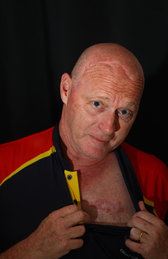 Two years before doctors found his brain tumour, Mr Collier had a melanoma removed from his wrist and underwent a full-thickness skin graft using skin from his chest. Picture: Alison Wynd