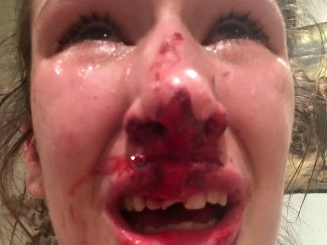 The 19-year-old alleges she was punched twice. Picture: Facebook