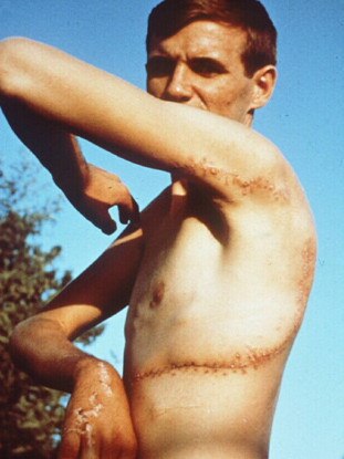 Rodney Fox reveals his scars from a Great White shark attack in 1963.