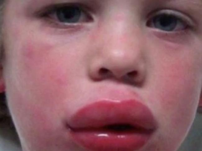 'Allergy bullies' have been accused of spiking the food of kids with food allergies, with some school children even being hospitalised. Picture: 7 News