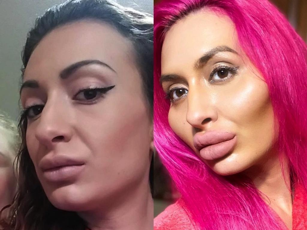 After first trying cheek fillers she ‘fell in love’. Picture: Instagram