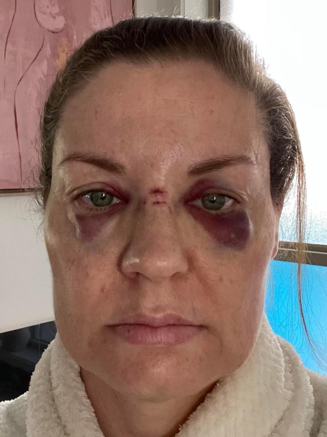 Rebecca Howe was left black-eyed and bleeding after Axl Rose's microphone hit her in the face.