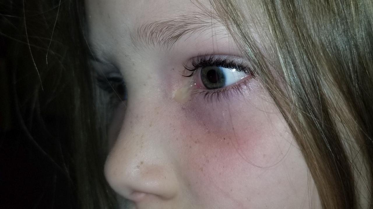 A mum caught stomach-churning photographs of the moment a giant beetle came out from behind her daughter’s eye. Picture: Kennedy News Media