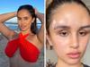 ‘Fox eye surgery left me with horns’
