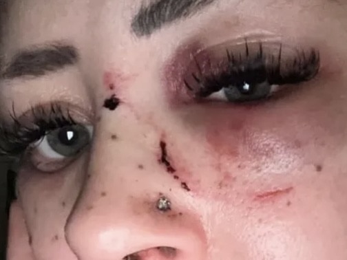 Tori-Lee Hellsten has suffered multiple facial fractures after she was allegedly assaulted during a road rage outburst at Blaxland Rd in Campbelltown.