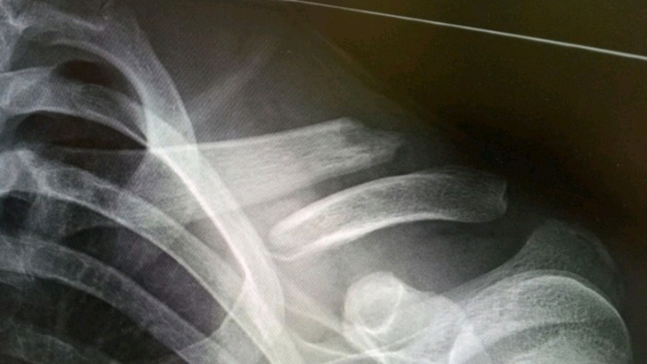 An x-ray showing Blake Cubby's broken collar bone after he was allegedly assaulted at a St George Junior Rugby League Carnival.