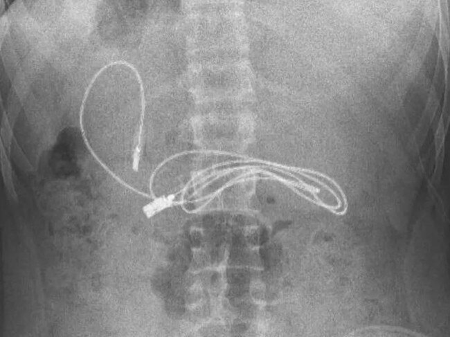 A boy in Turkey had a charging cable stuck in his stomach. @prof.dr.yasardogan