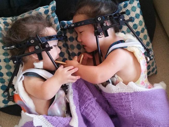 Maddy and Briella were in the halo frames for six and eight months. Picture: Instagram