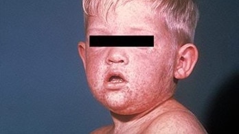 Measles cases are most easily recognised by a red, blotchy rash that spreads from the head to the rest of the body. Picture: Supplied