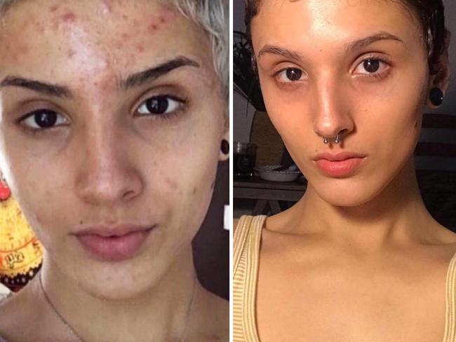 Woman goes viral after sharing amazing before and after photos, and revealing her acne cure.