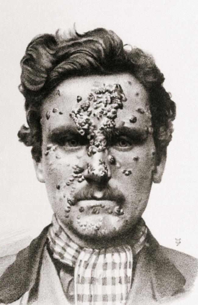 Lesions of secondary syphilis on a man's face.