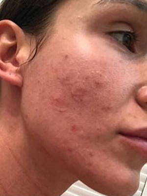 Kayla Itsines shared a photo of her skin covered in acne. Picture: Instagram / Kayla Itsines