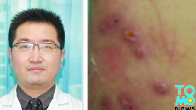 Chinese man returns home with maggots under skin