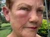 Pauline Hanson suffers ‘painful’ insect stings - but not everyone has sympathy. Picture: Facebook