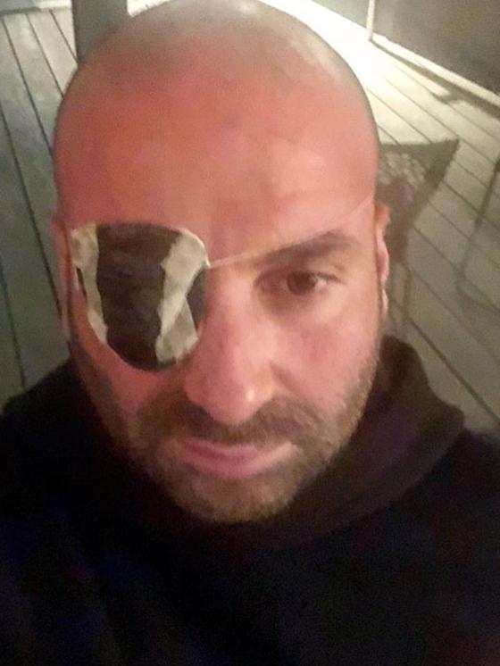 Calombaris’ retina suffered multiple tears after he was accidentally walloped in the eye by a squash ball. Picture: Instagram/@gcalombaris