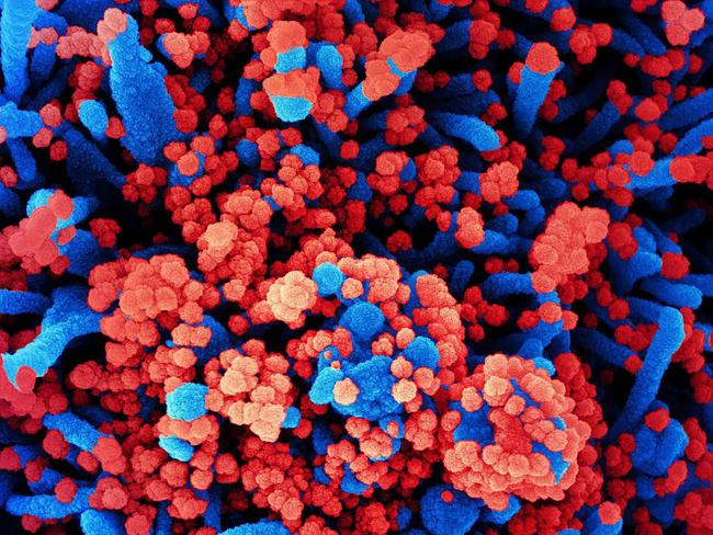 This undated handout image obtained July 28, 2020, courtesy of National Institute of Allergy and Infectious Diseases(NIH/NIAID), shows a colorized scanning electron micrograph of a cell (blue) heavily infected with SARS-CoV-2 virus particles (red), isolated from a patient sample. (Photo by - / National Institute of Allergy and Infectious Diseases / AFP) / RESTRICTED TO EDITORIAL USE - MANDATORY CREDIT 