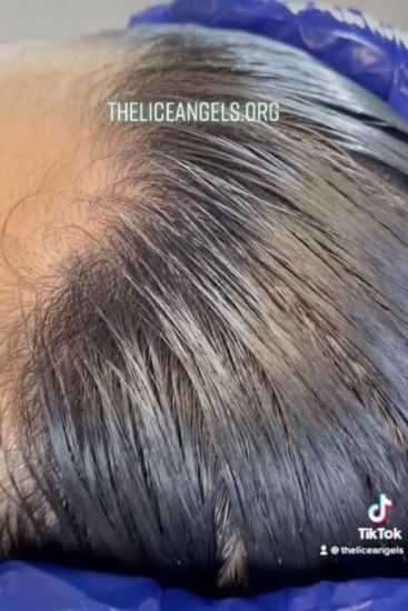 Is this the worst case of head lice ever? Video shows girl infested with  HUNDREDS of nits - World News - Mirror Online