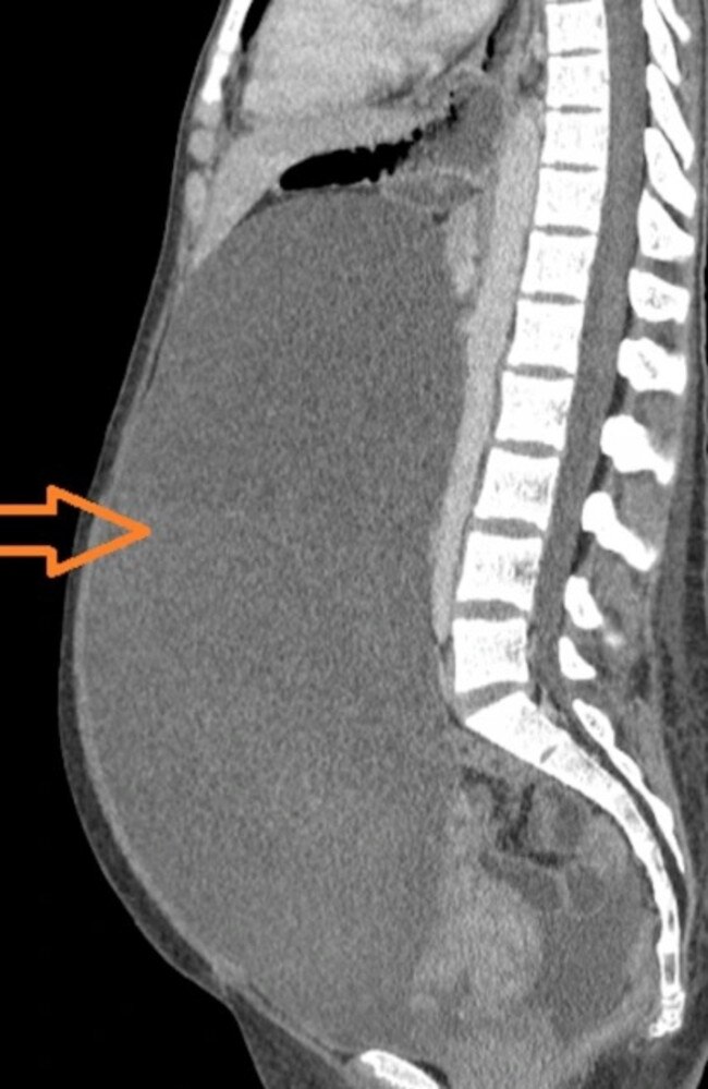 A scan showing the 12.7kg, 116cm cyst that took up almost the entirety of Sarah’s abdomen. Picture: Triangle News