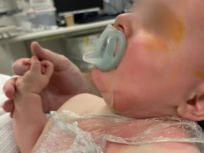 Baby Luka suffered burns to his face and chest. Picture: ABC News