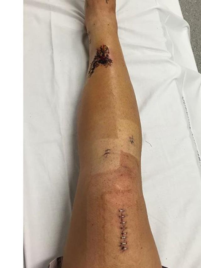 Jake Stone’s leg while he was in hospital.