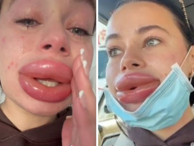 She could not believe her lips has swollen so much.