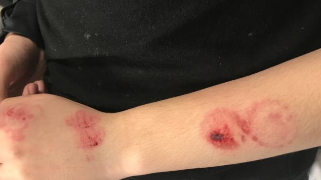 The waiter shows off his injuries after he was allegedly bitten by Quan after a dispute at the Nice Fish Chinese Restaurant. Picture: Supplied