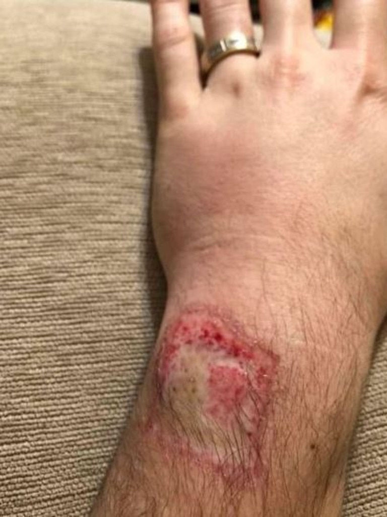 fitbit burning wrist