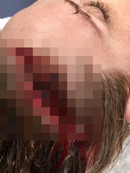 The charges relate to a female detention worker who was almost scalped and knocked unconscious when a teen detainee hit her in the head with a guitar